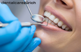 Nettoyage dentaire professionnel chez dentalcarezürich